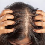 Forfora o dermatite seborroica