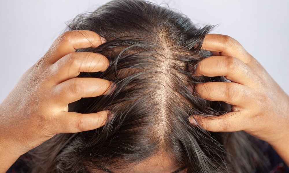 Forfora o dermatite seborroica