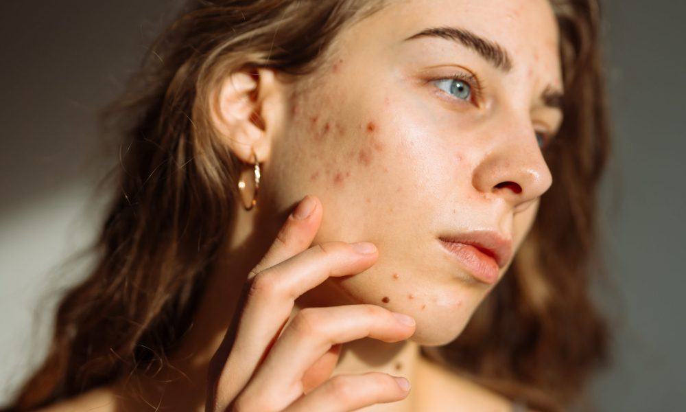 acne ormonale