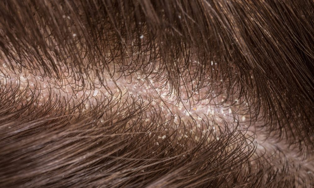 come eliminare la forfora